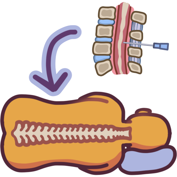 A person lying on their side, with their spine illustrated down their back. An arrow points between them and a cross section of a spine with a syringe in one side of it.